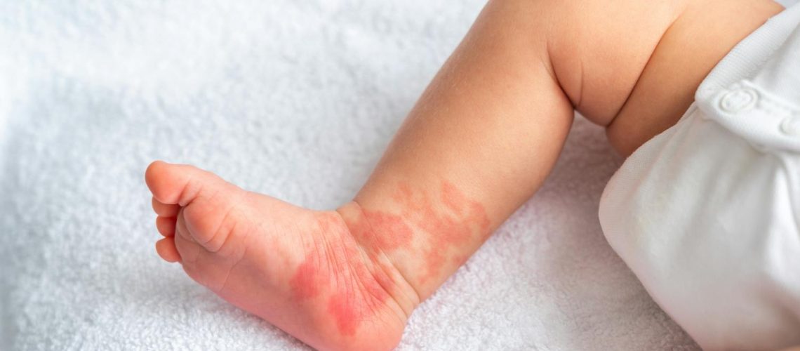 Angiome et hémangiome : quelle est cette tache sur mon bébé ?